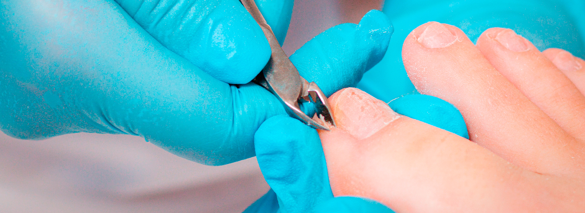 Ongle incarné