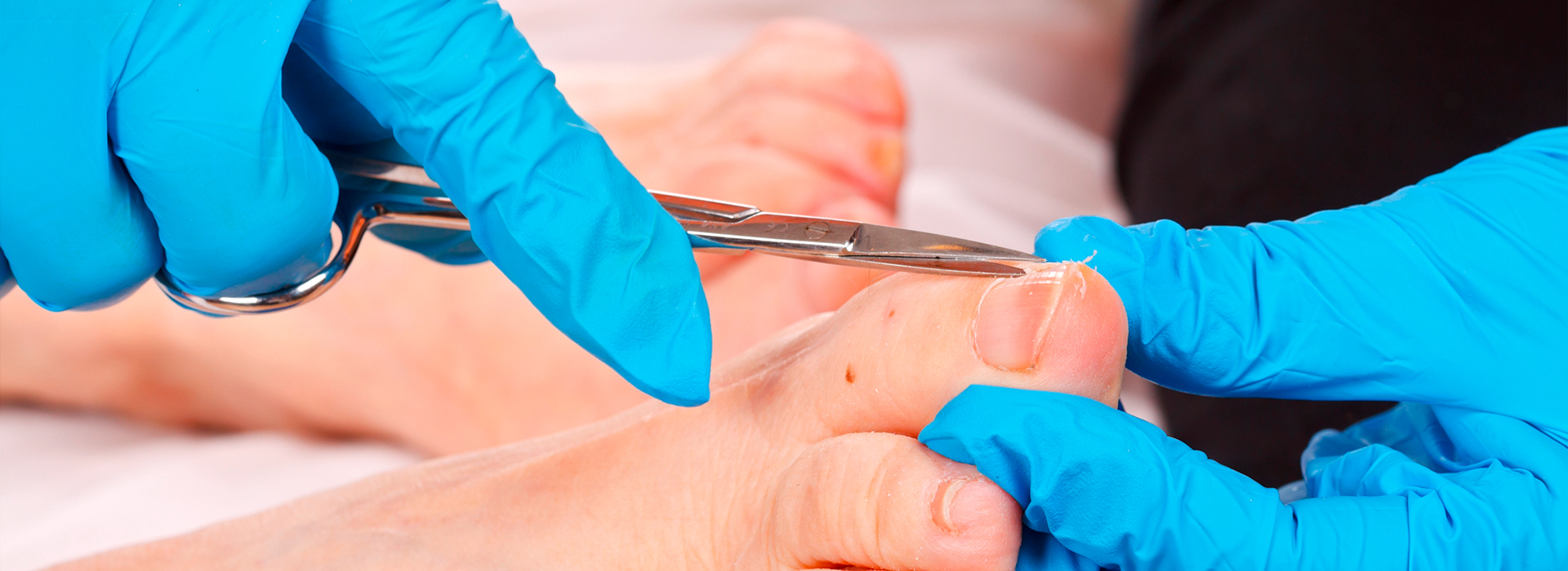 Ongles difformes, épais et jaunis