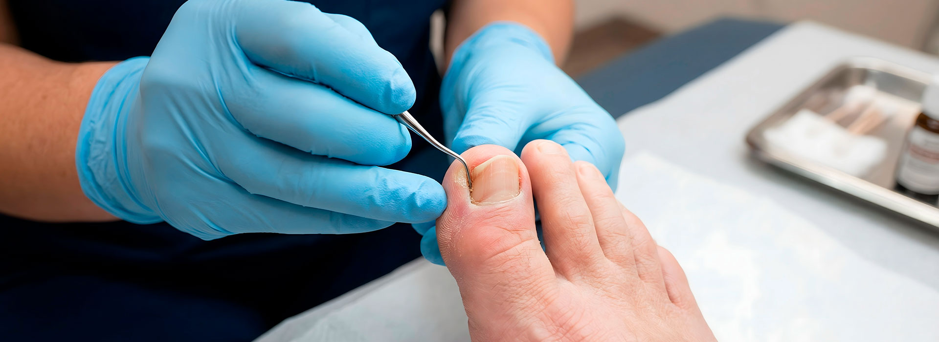 Ongles difformes, épais et jaunis